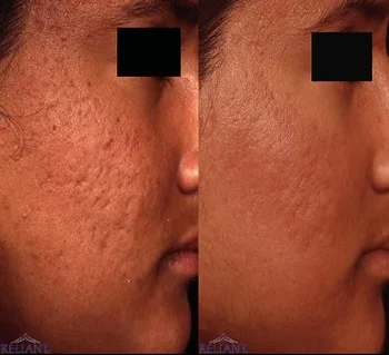 acne-scars-treatments-500x500